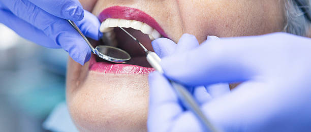 Best Emergency Wisdom Tooth Extraction in Downs, IL